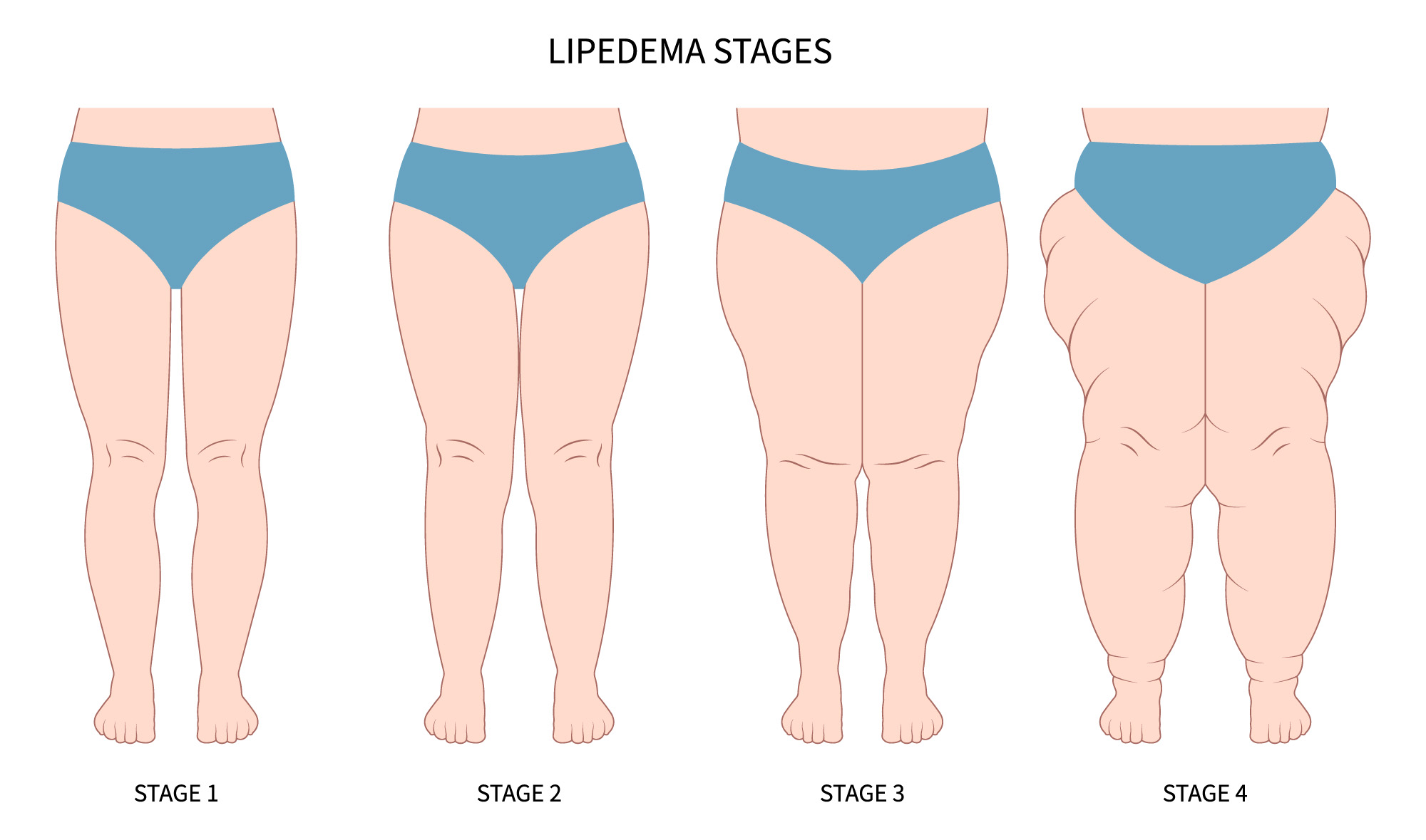 https://www.plastischechirurgie-lipo.at/wp-content/uploads/2023/05/lipedema-grade.jpg