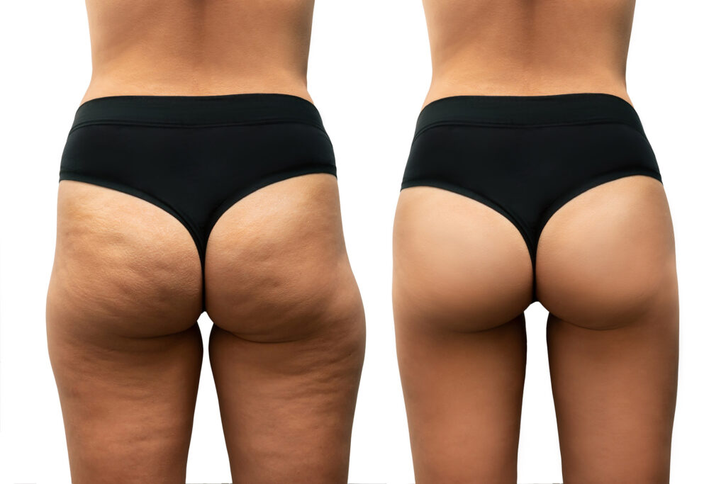Fettabsaugung – Liposkulptur ästhetische Chirurgie Privatklinik